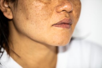 Can CBD help with hyperpigmentation?